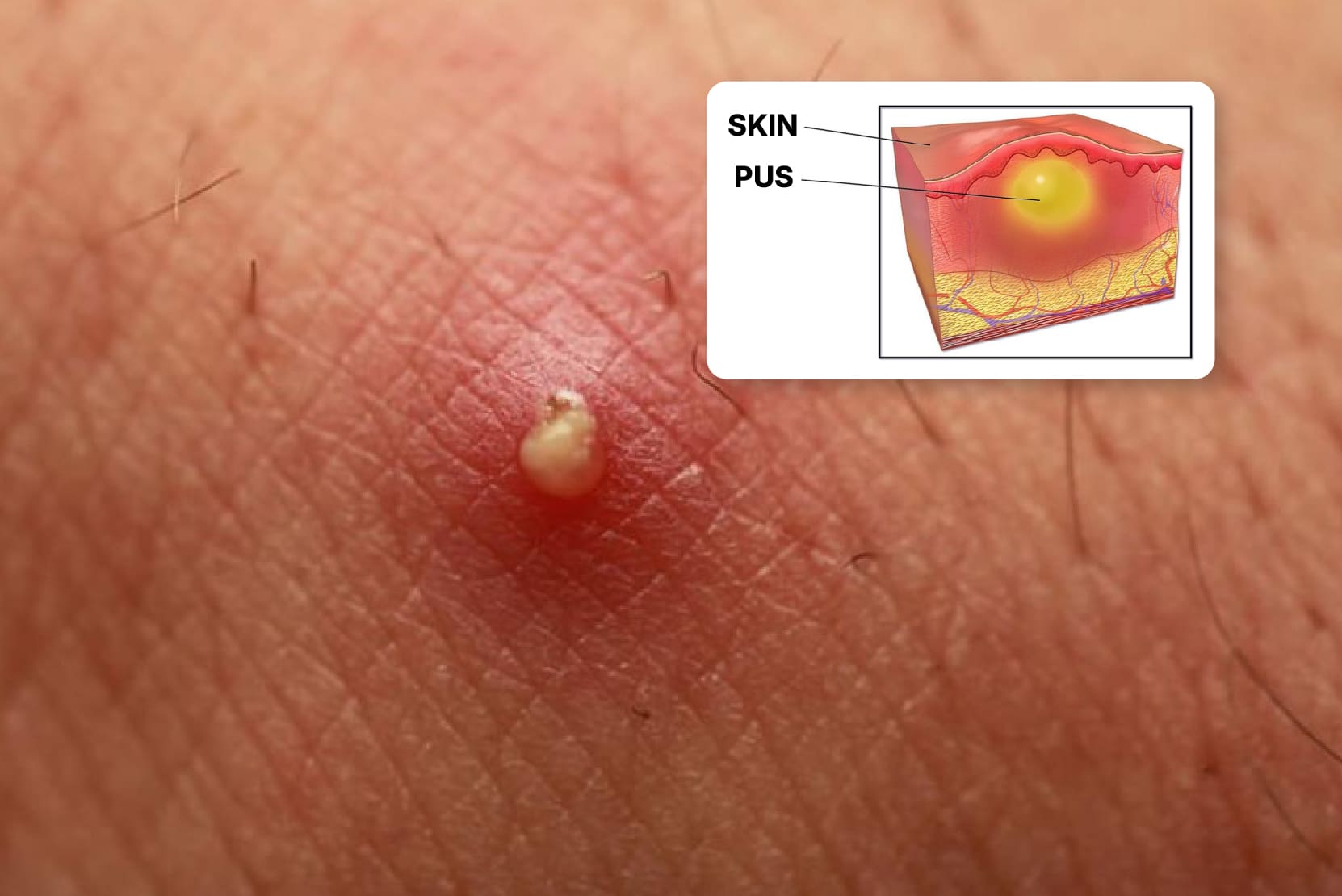 Abscess/Boils